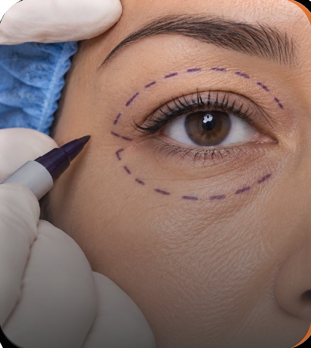 Blefaroplastia